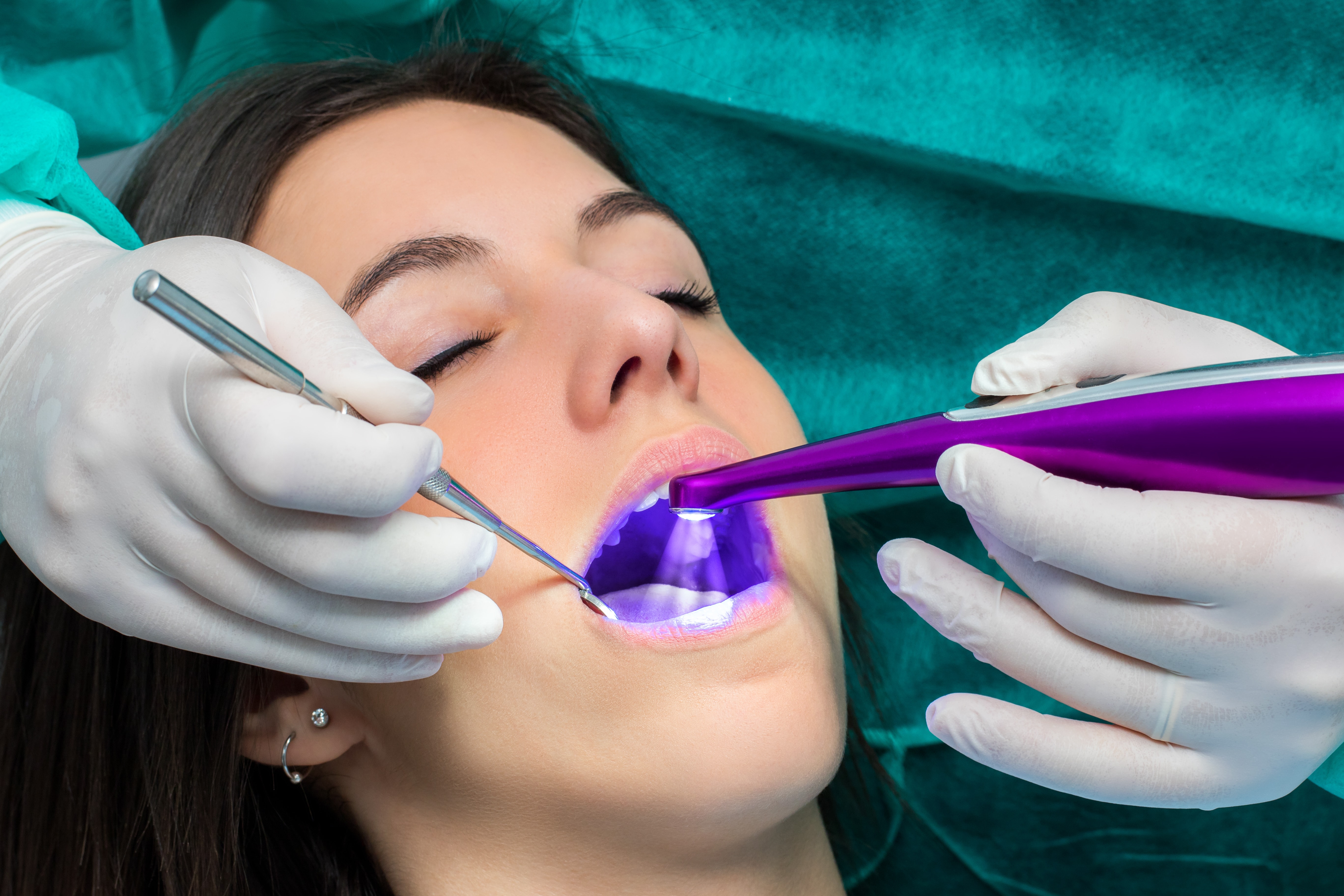 Dentist applying dental sealant Dentist applying dental sealant